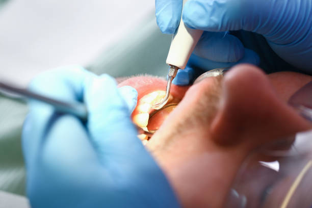 Best Emergency Treatment for Dental Infections or Abscesses in San Martin, CA