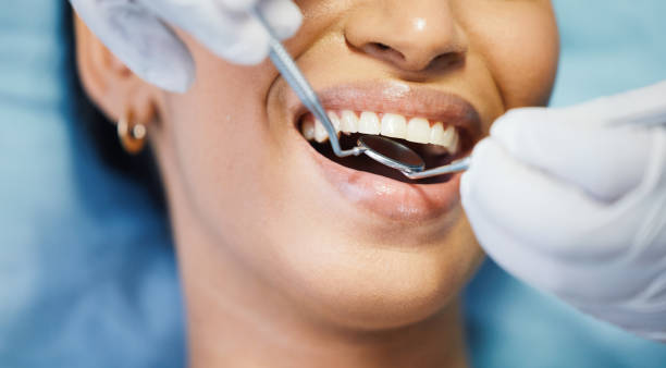 Best Emergency Tooth Extraction in San Martin, CA