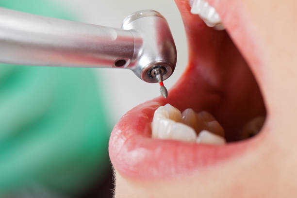 Best Emergency Dental Care for Broken or Chipped Teeth in San Martin, CA
